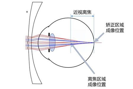 離焦眼鏡需要一直戴嗎