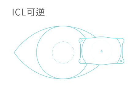 2021年做近視ICL手術多少錢？不可錯過