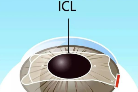 近視手術ICL晶體植入誰都適合做嘛?