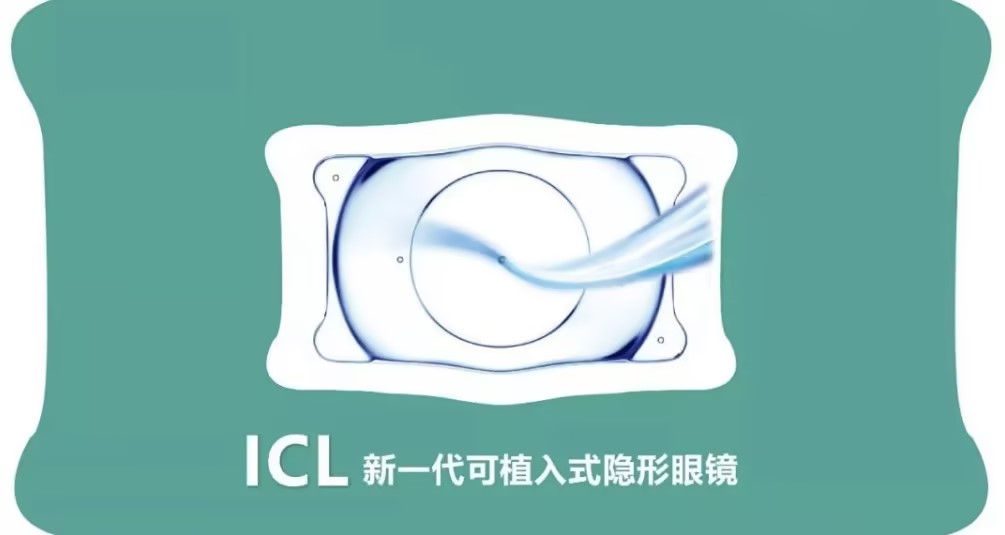 合肥ICL晶體植入近視手術，您了解多少？